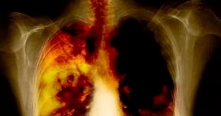 Cancro de pulmón.