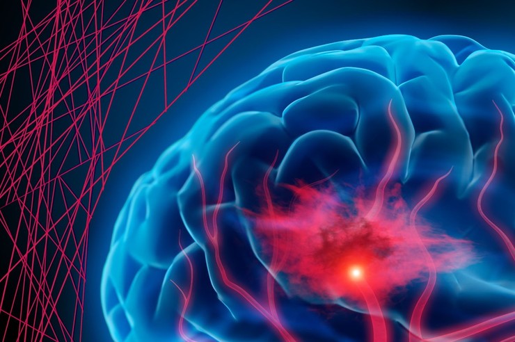 Hemorraxia intracerebral.