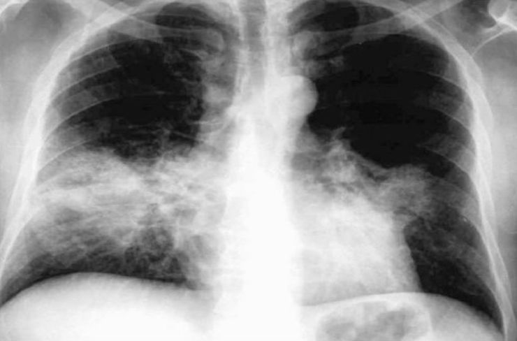 Pneumonía por lexionella.