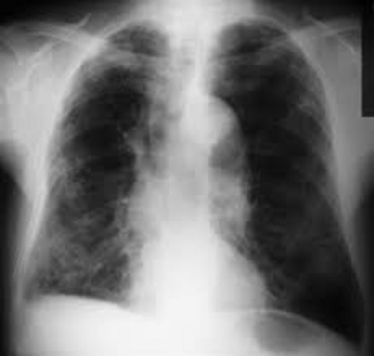 Radiografía de pulmóns 