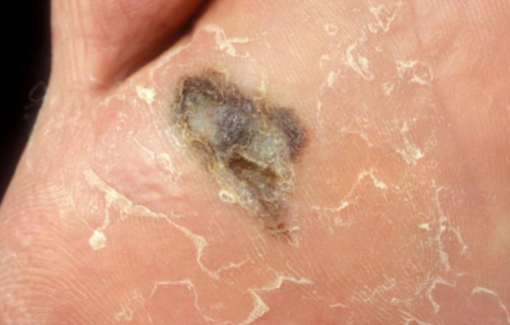 Imaxe dunha melanoma nun pé.. COLEXIO DE PODÓLOGOS DE GALICIA. 