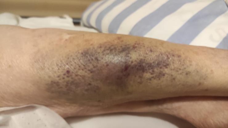 Hematomas nunha residente do centro DomusVi-Aldán 