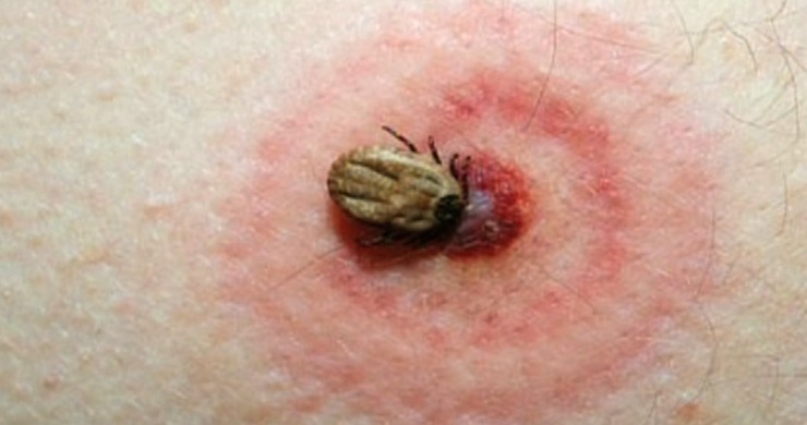 Enfermidade de Lyme causada por carrachos.