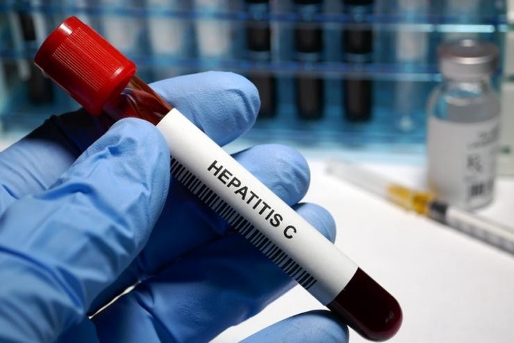 Hepatite C treatment  Hepatite C - sexually transmitted disease blood test and treatment. HAILSHADOW - Arquivo / Europa Press