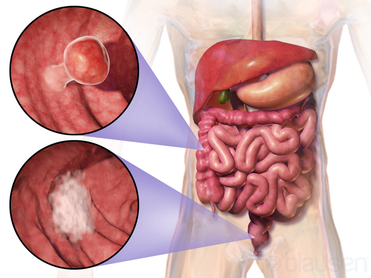 Cancro colorrectal 