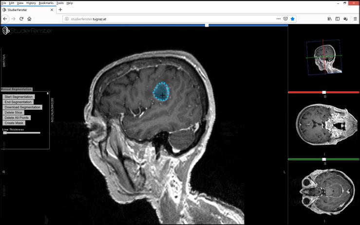 Tumor cerebral / EmmaWiki2020 - Wikimedia - Arquivo