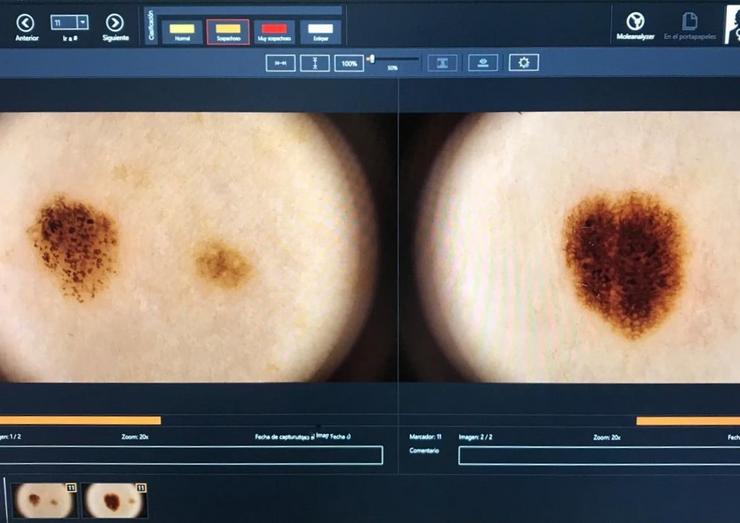 Dermatoscopia dixital na procura de melanomas ou cancros na pel / XUNTA - Europa Press