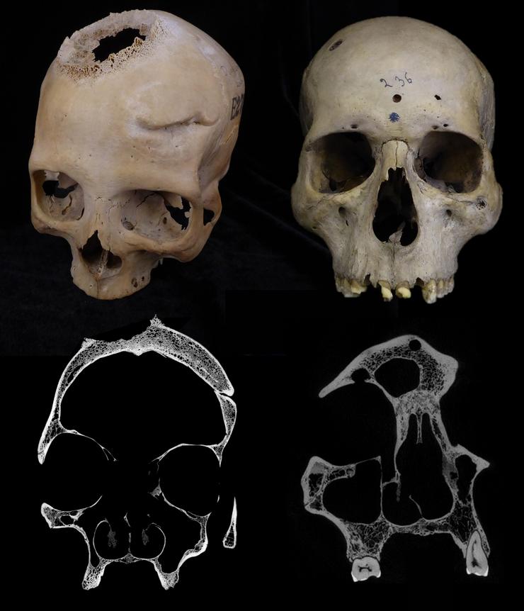 Un estudo da USC desvela que os exipcios practicaron intervencións para tratar o cancro hai 4.000 anos. USC / Europa Press