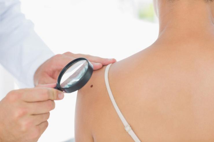 Arquivo - Lunares, cancro de pel, melanoma. WAVEBREAKMEDIA LTD - Arquivo 