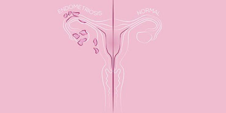 Endometrose / Europa Press