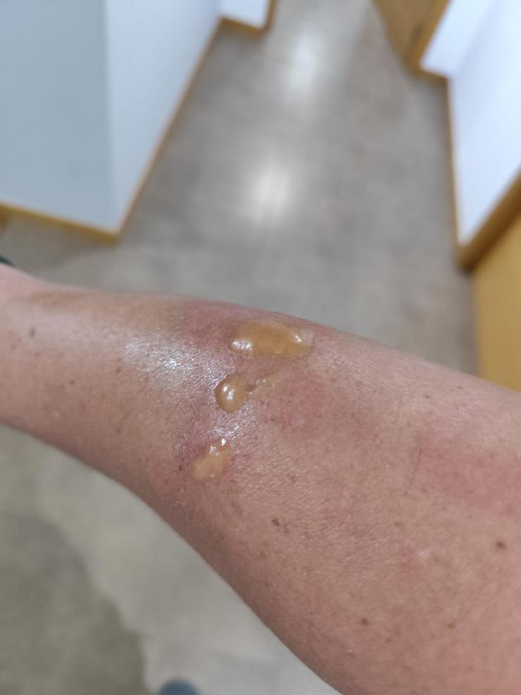 Queimada en brazo de brigadista por deficiencia en roupa ignífuga 